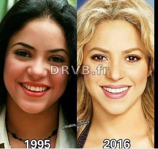 Shakira et la chirurgie esthétique : la vérité sur sa métamorphose